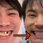 10年間も歯磨きしなかった山ちゃんの歯を600万円かけて治してみた【ドッキリ】